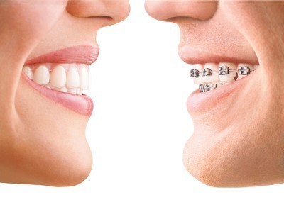 Invisalign mulford dental 2 (Custom)